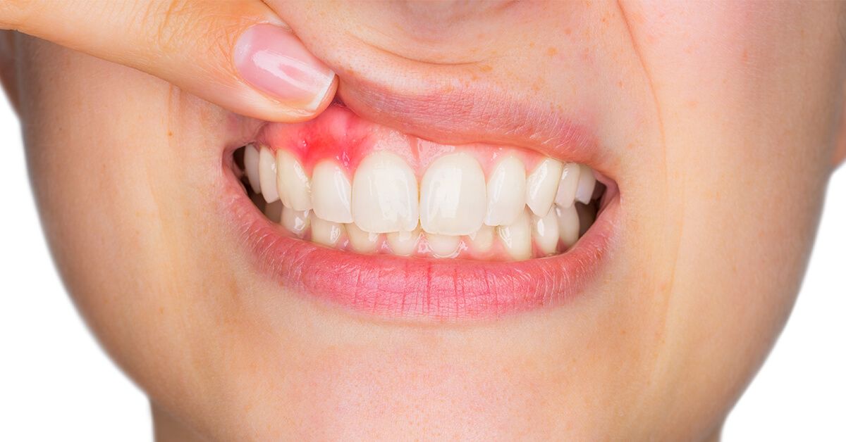 tratamento gengivite sp | periodontite dentista consolação