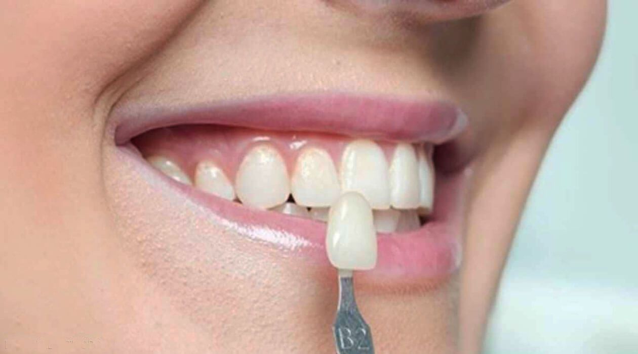 lente de contato dental | consolação sp